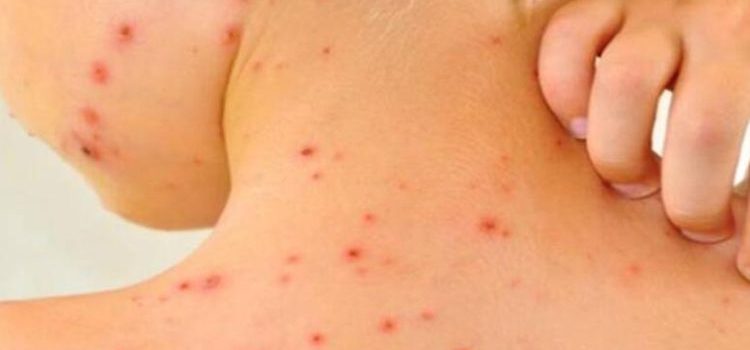 BC entra en alerta por casos de sarampión en Estados Unidos