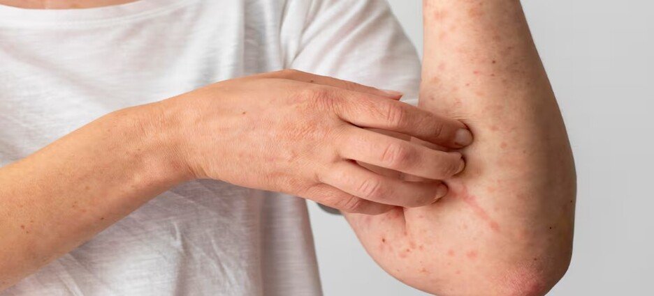 Preparan centros de vacunación en Ayuntamiento de Mexicali tras Alerta Roja de Sarampión